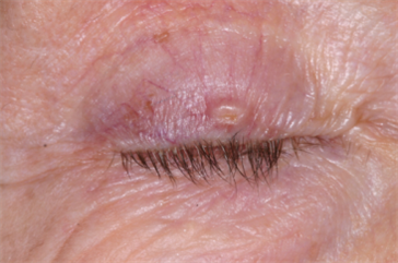 Right upper eyelid basal cell carcinoma