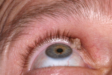 Right upper eyelid seborrheic keratosis