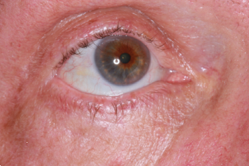 Right lower eyelid marginal basal cell carcinoma