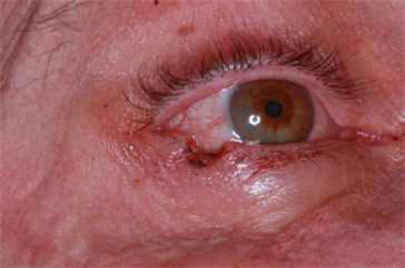 Small right lower eyelid Mohs' defect