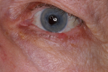 Left lower eyelid basal cell carcinoma