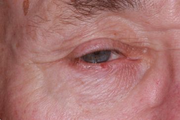 Right lower eyelid squamous cell carcinoma