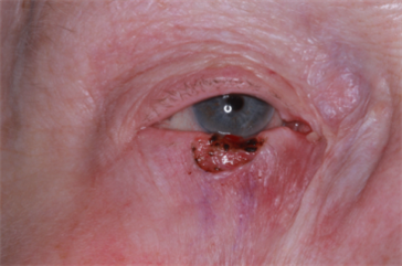 Right lower eyelid Mohs' defect
