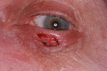 Left lower eyelid Mohs' defect