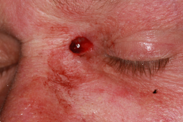 Left medial canthus basal cell carcinoma