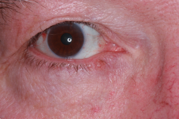 Right lower eyelid basal cell carcinoma medial
