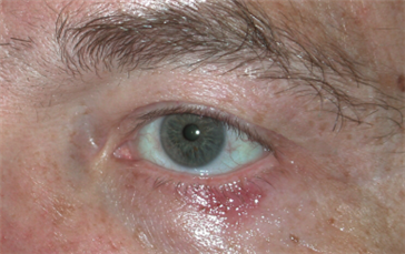 Basal cell carcinoma, left lower eyelid