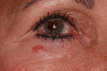 Right lower eyelid basal cell carcinoma