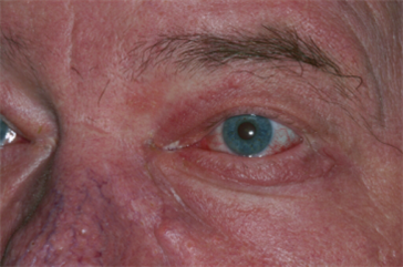 Left lower eyelid advancement flap