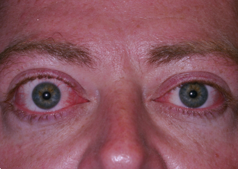 Bilateral Proptosis (Bulging Eyes)
