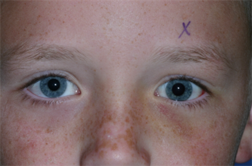 Baseball to the left eye "White-Eyed" blow out fracture