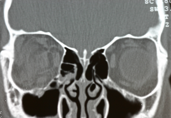 CT Scan showing small fracture with entrapment