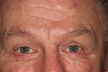 Male 75 upper lower bleph, brow after.jpg