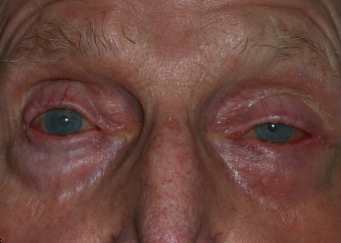 Ectropion 90 year old after.jpg