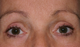 Brow & Forehead Lift after
