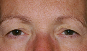 Brow & Forehead Lift before