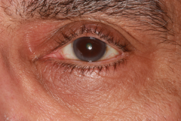 Post-op 3 months left upper eyelid repair