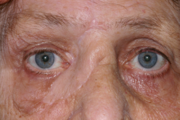 Post-op right lower eyelid after glabellar flap repair