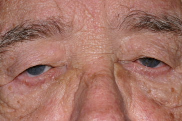 Male pre-op brow lift with severe brow descent