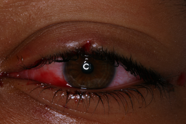 Pre-op laceration left upper eyelid