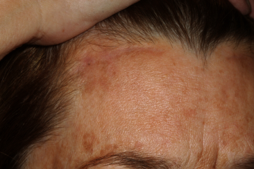 Right Side Pretrichial Scar