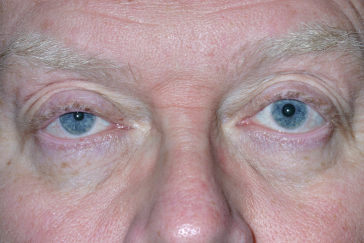 Male pre-op ptosis repair with drooping right upper eyelid