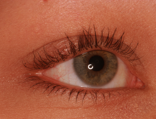 Post-op laceration right upper eyelid