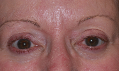 Female post-op ptosis and lower blepharoplasty with improved eyelid height and lower lid contour