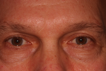 Male post-op brow lift and blepharoplasty with improved lid and brow position
