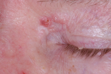 Pre-op basal cell carcinoma of medial canthus and left upper eyelid