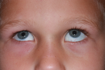 After orbital fracture repair showing normal upgaze left eye