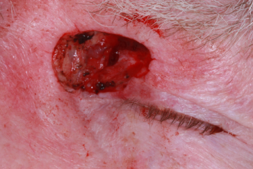 Pre-op medial canthus and left upper eyelid Mohs' defect