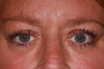 Female post-op ptosis with improved left upper eyelid