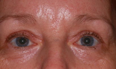 Female post-op blepharoplasty and brow lift with improved lid and brow position