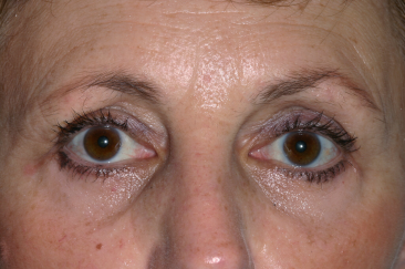 Post-op after left upper eyelid retraction repair