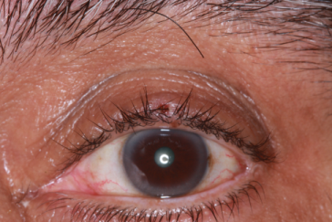 Pre-op Basal Cell Carcinoma left upper eyelid