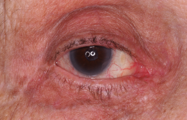 Post-op repair right lower eyelid laceration