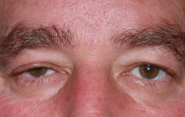 Male post-op ptosis repair and blepharoplasty with drooping right upper eyelid and excess upper eyelid skin