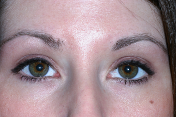 Female post-op ptosis repair with improved eyelid height