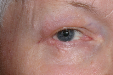 Post-op 3 months after repair