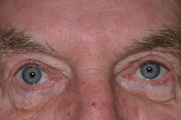 Male post-op blepharoplasty, ptosis repair and brow lift with improved eyelid position