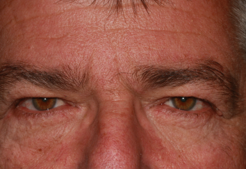 Male pre-op brow lift with brow descent