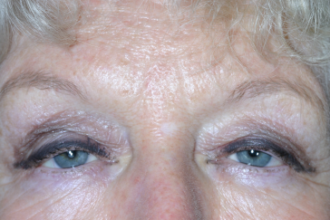 Female pre-op ptosis with drooping eyelids
