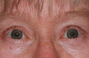 Female post-op ptosis and blepharoplasty with improved eyelid position