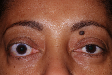 Right Upper Eyelid Retraction, pre-op