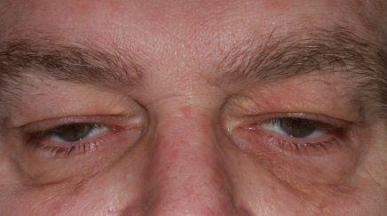 Male pre-op ptosis repair, upper blepharoplasty and brow lift with heavy upper eyelids