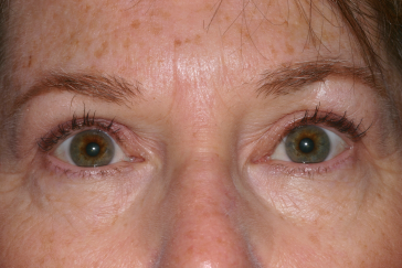 Female post-op ptosis and blepharoplasty with improved eyelid position