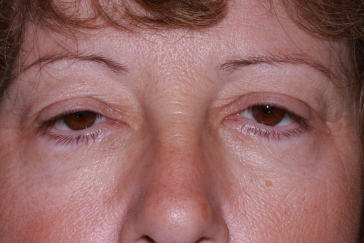 Female post-op ptosis, blepharoplasty and brow lift with drooping eyelids and excess skin