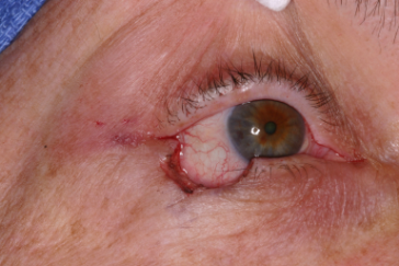 Right lower eyelid Mohs' defect