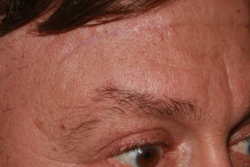 Right Side Mid-Brow Scars